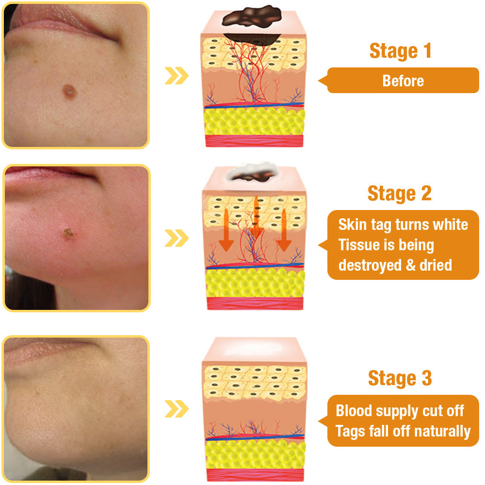 🍃[👨‍⚕AAD RECOMMENDS] ZVLZVL™ Bee Venom Mole and Wart Treatment Cream🔥Limited time 50% OFF🔥( Suitable for use byindividuals of all ages)