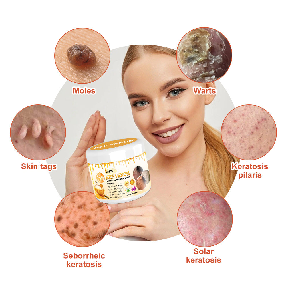 🍃[👨‍⚕AAD RECOMMENDS] ZVLZVL™ Bee Venom Mole and Wart Treatment Cream🔥Limited time 50% OFF🔥( Suitable for use byindividuals of all ages)