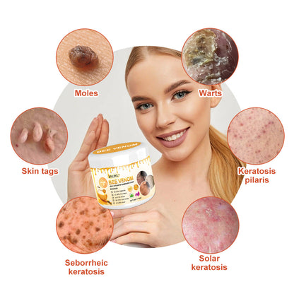 🍃[👨‍⚕AAD RECOMMENDS] ZVLZVL™ Bee Venom Mole and Wart Treatment Cream🔥Limited time 50% OFF🔥( Suitable for use byindividuals of all ages)