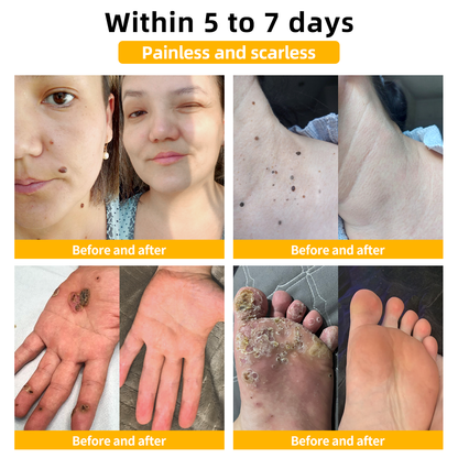 🍃[👨‍⚕AAD RECOMMENDS] ZVLZVL™ Bee Venom Mole and Wart Treatment Cream🔥Limited time 50% OFF🔥( Suitable for use byindividuals of all ages)