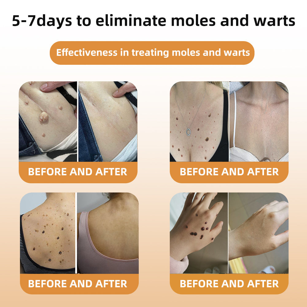 🍃[👨‍⚕AAD RECOMMENDS] ZVLZVL™ Bee Venom Mole and Wart Treatment Cream🔥Limited time 50% OFF🔥( Suitable for use byindividuals of all ages)