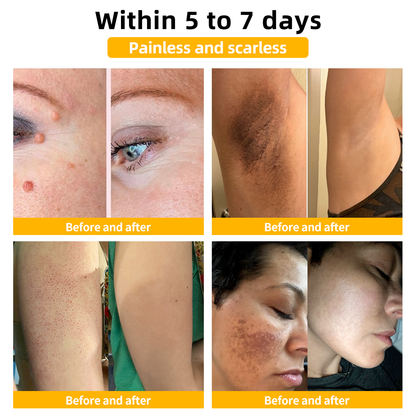 🍃[👨‍⚕AAD RECOMMENDS] ZVLZVL™ Bee Venom Mole and Wart Treatment Cream🔥Limited time 50% OFF🔥( Suitable for use byindividuals of all ages)