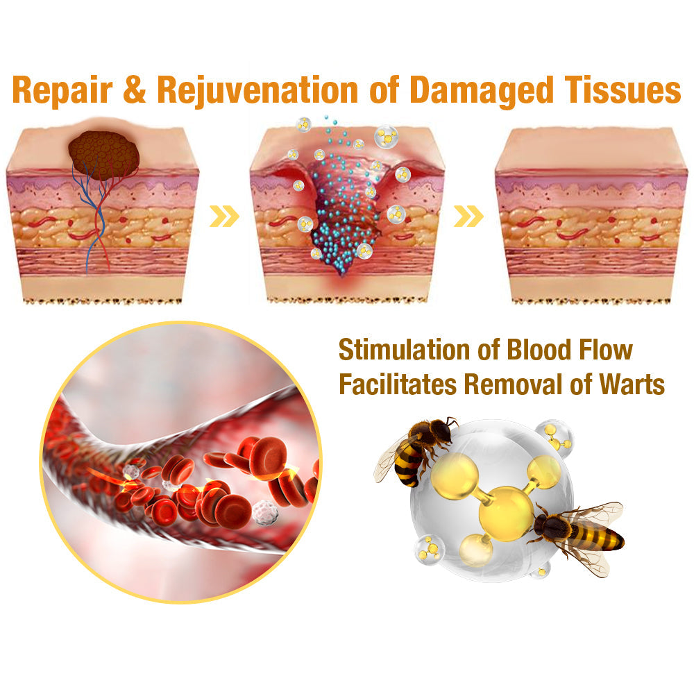 🍃[👨‍⚕AAD RECOMMENDS] ZVLZVL™ Bee Venom Mole and Wart Treatment Cream🔥Limited time 50% OFF🔥( Suitable for use byindividuals of all ages)