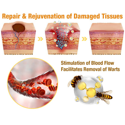 🍃[👨‍⚕AAD RECOMMENDS] ZVLZVL™ Bee Venom Mole and Wart Treatment Cream🔥Limited time 50% OFF🔥( Suitable for use byindividuals of all ages)